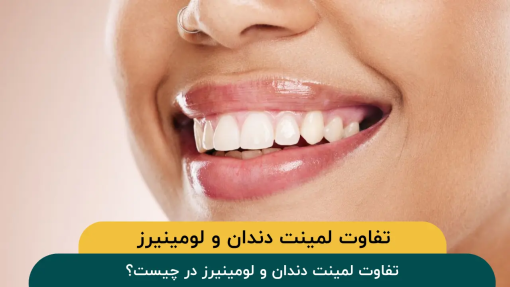 تفاوت-لمینت-دندان-و-لومینیرز-در-چیست